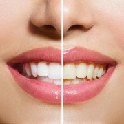 Wybielanie zębów w gabinecie p2-dental.pl