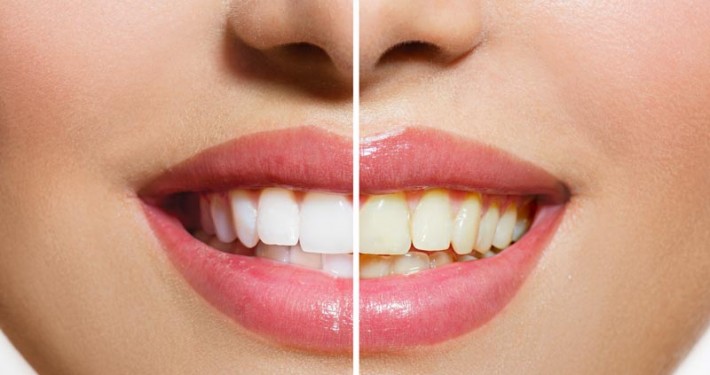 Wybielanie zębów w gabinecie p2-dental.pl