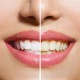 Wybielanie zębów w gabinecie p2-dental.pl